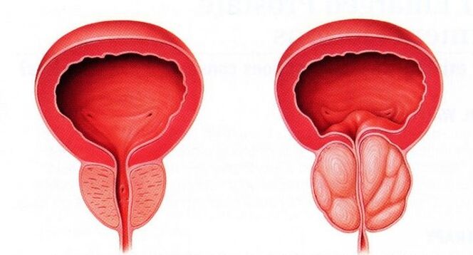 sveika ir uždegta prostata sergant lėtiniu prostatitu