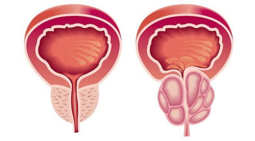 Sveika ir uždegta prostata su prostatitu