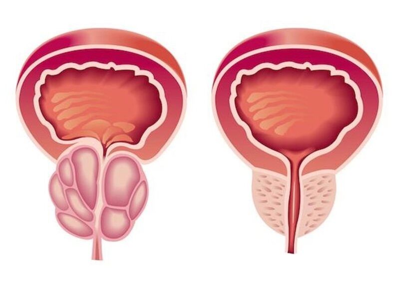 Kaip atrodo prostatitas